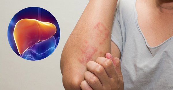 5 dấu hiệu trên khuôn mặt cảnh báo cần khám gan càng sớm càng tốt