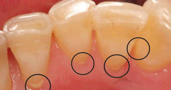 7 biện pháp loại bỏ cao răng tại nhà