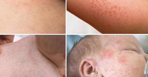 876 ca bệnh sởi chỉ trong 2 tháng đầu năm, Hà Nội đẩy mạnh tiêm vaccine để ngăn dịch sởi