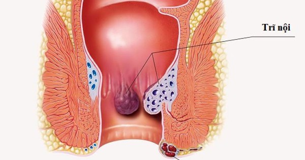 Bài tập giảm tái phát cho người bệnh trĩ