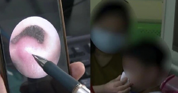 Bé 8 tuổi nhiễm trùng nội sọ, suýt mất mạng vì 1 thói quen khi rảnh rỗi