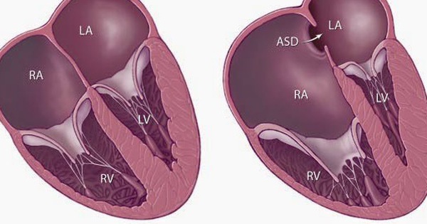 Bé 9 ngày tuổi bỏ bú, tím tái cơ thể, bác sĩ phát hiện bệnh nhi dị tật tim bẩm sinh