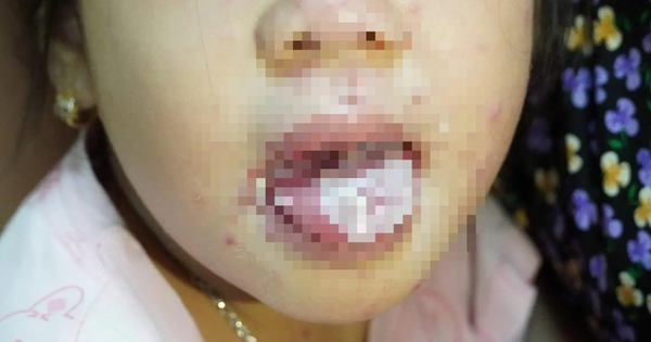 Bé gái bị nhiễm trùng nặng, miệng không thể ăn uống do mắc thủy đậu