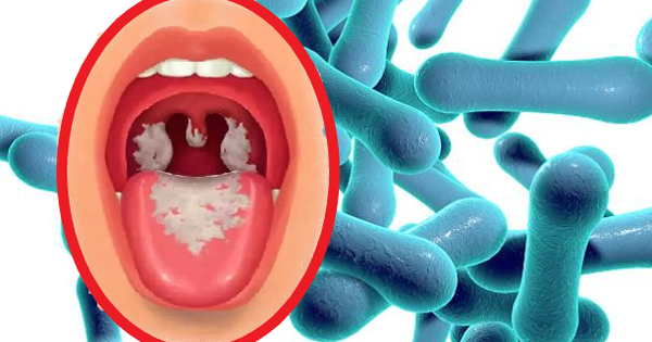 Bệnh bạch hầu có gì khác với bệnh viêm họng, viêm amidan?