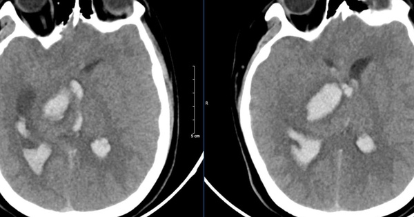 Bệnh nhân 15 tuổi tử vong sau khi bị đau đầu đột ngột, bác sĩ cảnh báo các dấu hiệu cần đến bệnh viện ngay