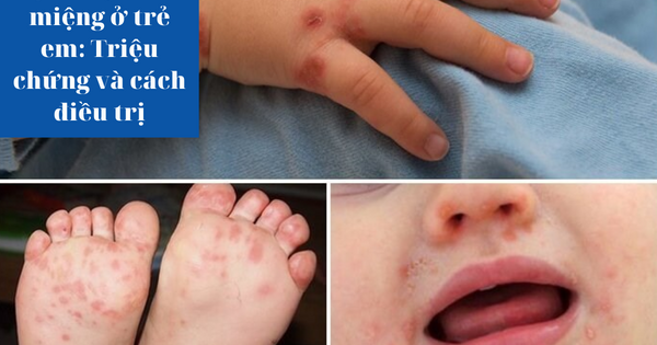 Bệnh tay chân miệng ở trẻ em: Triệu chứng và cách hỗ trợ cải thiện