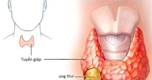 Các dấu hiệu điển hình của ung thư tuyến giáp ai cũng cần biết