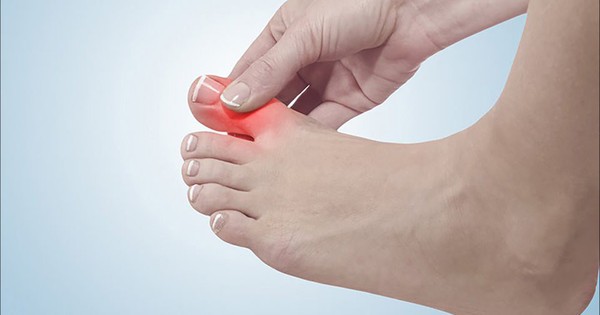 Cách phân biệt đau do mắc gout và viêm khớp dạng thấp