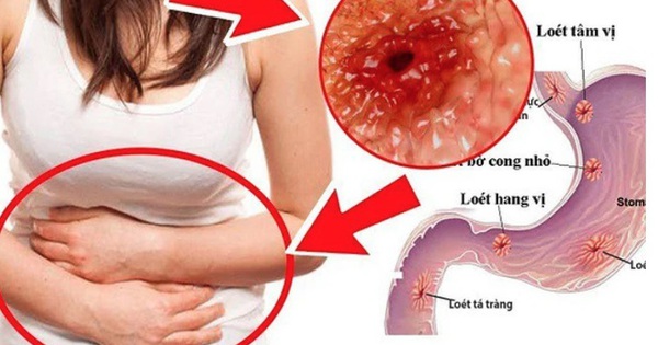 Cảnh giác với 5 nguyên nhân gây ung thư dạ dày, đây là 7 dấu hiệu điển hình cần được khám sớm!