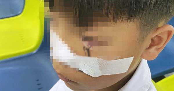 Cấp cứu bé trai 11 tuổi bị lưỡi câu sắc nhọn móc vào mắt khi đùa giỡn