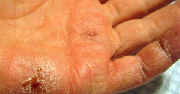 Da nứt nẻ vì hanh khô, bác sĩ bày cách xử lý