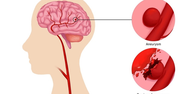 Đau đầu đột ngột coi chừng phình động mạch não