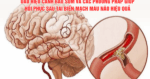 Dấu hiệu cảnh báo sớm và các phương pháp giúp hồi phục sau tai biến mạch máu não hiệu quả