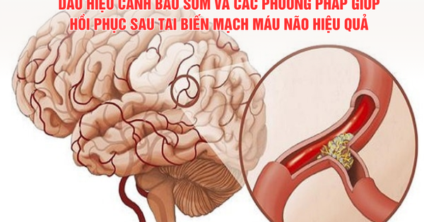Dấu hiệu cảnh báo sớm và các phương pháp giúp hồi phục sau tai biến mạch máu não hiệu quả