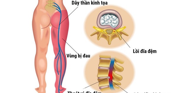 Đau thần kinh tọa – Nguyên nhân và cách hỗ trợ cải thiện