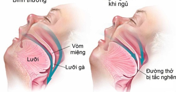 Hay buồn ngủ ban ngày, ngủ ngáy, mệt mỏi khi thức dậy, cần lưu ý hội chứng nguy hiểm này