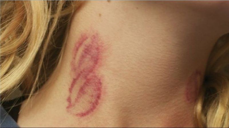 Hickey là gì?