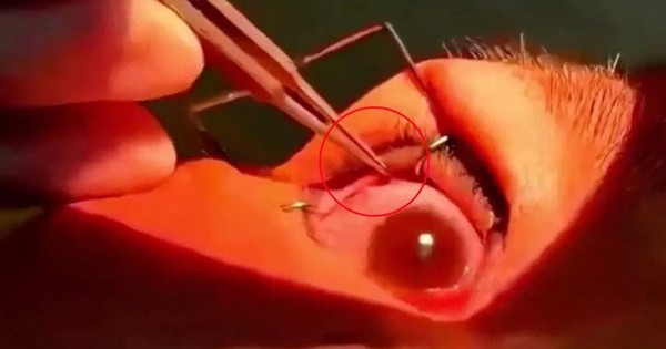 Hơn 60 con giun bò ngoe nguẩy trong mắt người phụ nữ