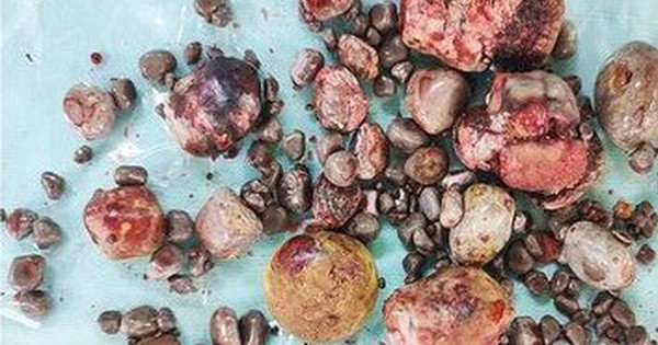 Lấy ra hơn 100 viên sỏi thận cho một bệnh nhân