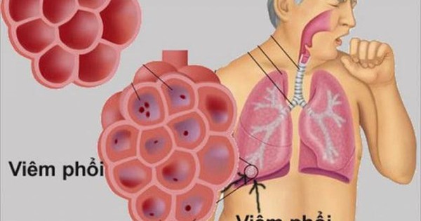 Mẹo kiểm soát bệnh viêm phổi mùa đông