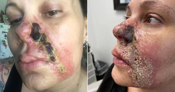 Nghiện tiêm filler, người phụ nữ bị mục nát và rụng một bên mũi