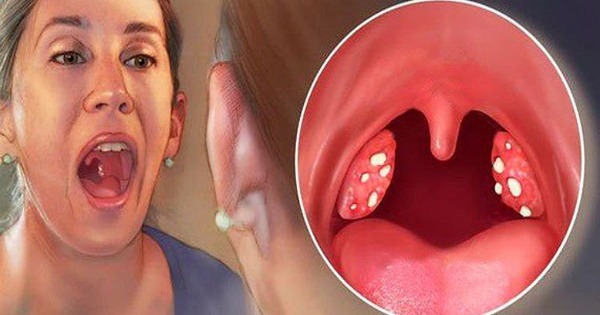 Người bị viêm họng hạt cần làm gì để nhanh khỏi? Đây là 4 bài thuốc chữa bệnh hiệu quả bằng mật ong