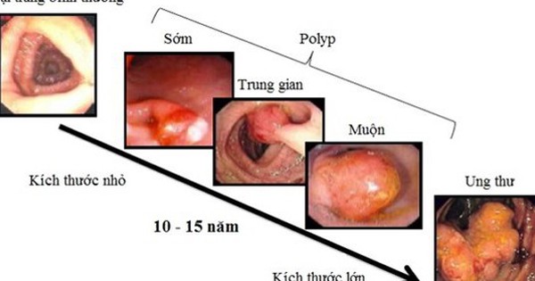 Người đàn ông ở Phú Thọ phát hiện mắc ung thư trực tràng từ một dấu hiệu nhiều người Việt bỏ qua