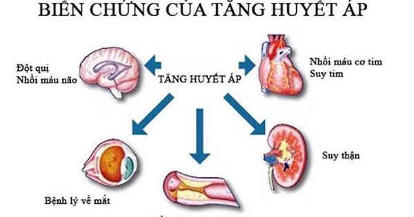 Người phụ nữ 35 tuổi ở Hà Nội bị suy thận, cao huyết áp thừa nhận một sai lầm nhiều người Việt mắc phải