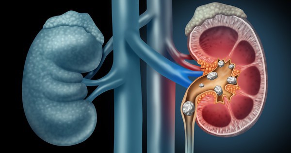 Những thói quen gây sỏi thận ít người biết