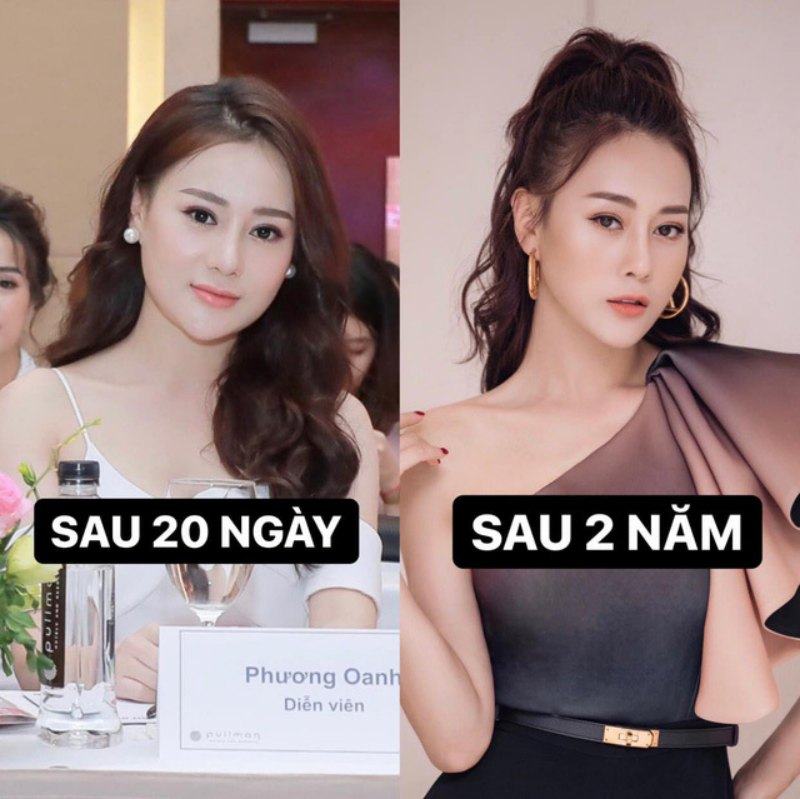 Quỳnh Búp Bê - Phương Oanh trước khi phẫu thuật thẩm mỹ