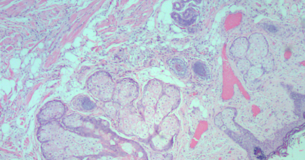 Polyp lông, bệnh hiếm gặp ở trẻ sơ sinh