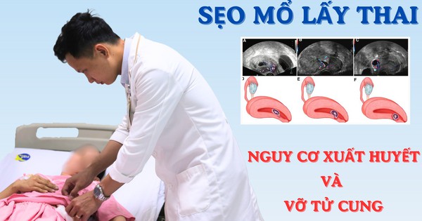 Sản phụ 40 tuổi ở Củ Chi nhập viện gấp vì thai bám ở sẹo mổ nguy hiểm