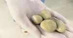 Sửng sốt với những viên sỏi to như viên đá trứng được lấy ra từ bàng quang người đàn ông ở Sơn La