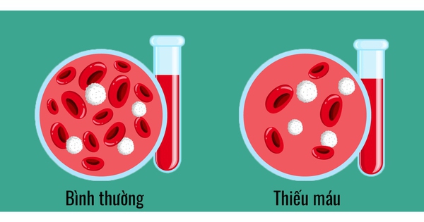 Thiếu máu: Nguyên nhân, dấu hiệu và cách điều trị