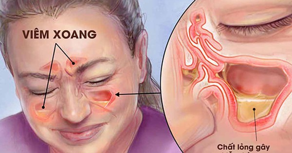 Thời tiết thay đổi, người bị viêm xoang cần làm gì để ngừa tái phát