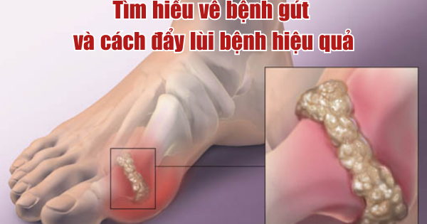 Tìm hiểu về bệnh gút và cách hỗ trợ kiểm soát bệnh