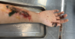 Tự đắp lá vào vết thương, nam bệnh nhân 17 tuổi suýt bị hoại tử cánh tay