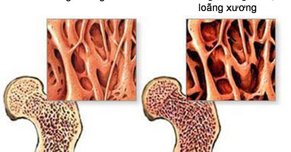 Xoa bóp bấm huyệt có lợi ích gì với người loãng xương?